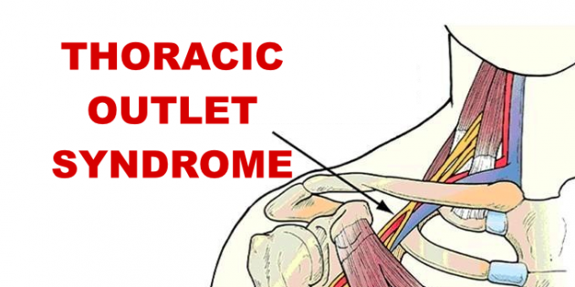 thoracic outlet syndrome exercises